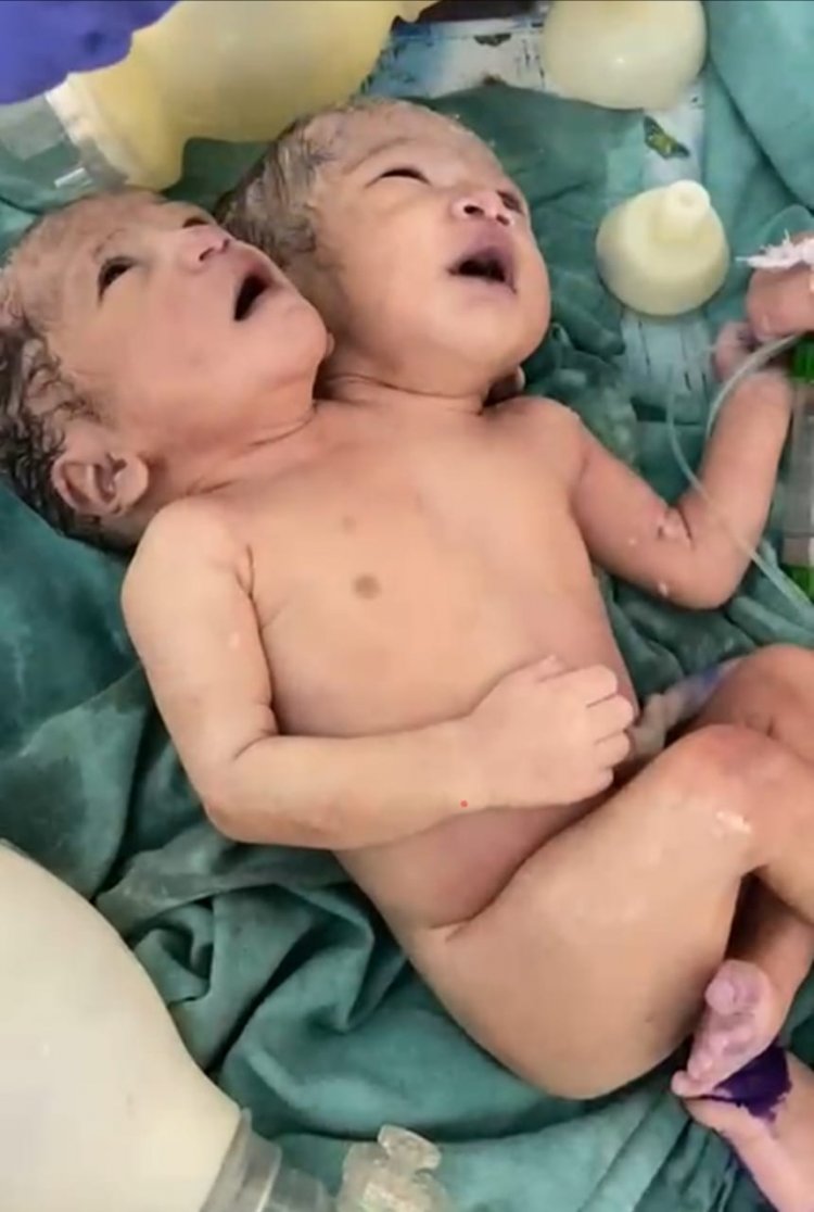 अजब-गजब: तन एक और सिर दो, दो सिर वाली बच्ची ने लिया जन्म